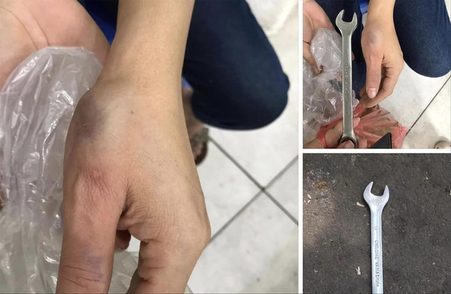 Chiếc cờ lê rơi từ trên cao làm bầm tím tay một phụ nữ ở chung cư HH Linh Đàm. Ảnh: NVCC Chiếc cờ lê rơi từ trên cao làm bầm tím tay một phụ nữ ở chung cư HH Linh Đàm. Ảnh: NVCC