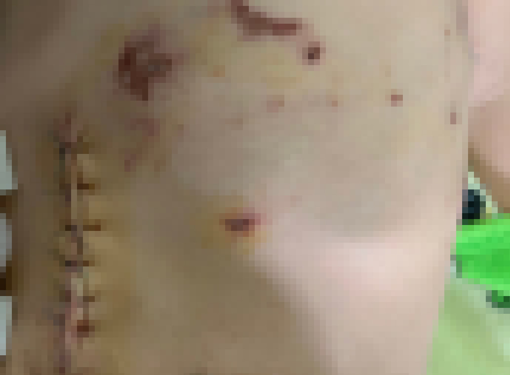 Vết thương do chó cắn trên người bé B.. Ảnh: PV Vết thương do chó cắn trên người bé B.. Ảnh: PV