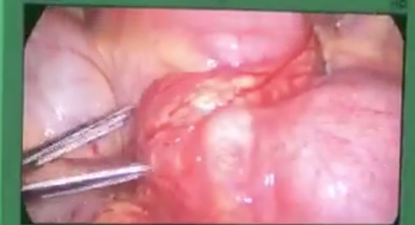 Tăm xỉa răng dài 6cm đâm thủng ruột bé trai 14 tuổi ảnh 1