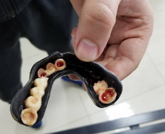 Võ sĩ Trung Quốc gãy liền 9 chiếc răng vì đồ bảo hộ rẻ tiền ảnh 1