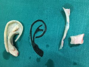 Thời điểm trước và ngay sau mổ tạo hình vành tai cùng với khung sụn làm từ sụn sườn của bệnh nhân. Ảnh: BV Việt - Đức Cậu bé 8 tuổi có tai mới làm từ ... sụn xương sườn ảnh 1