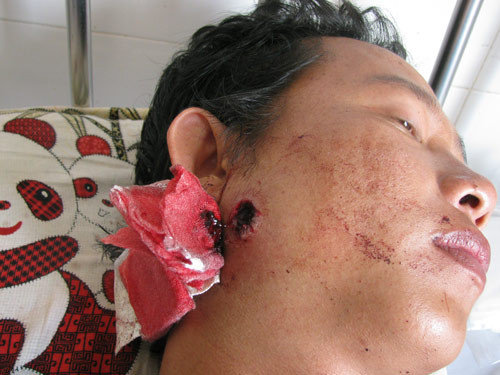 Vết thương do trung tá Dũng bắn anh Quang. Ảnh: người nhà cung cấp