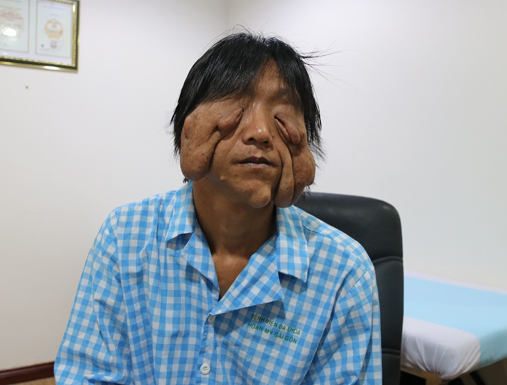 Mang khối u khổng lồ như 'mặt quỷ', người đàn ông 17 năm không dám ra khỏi nhà ảnh 1