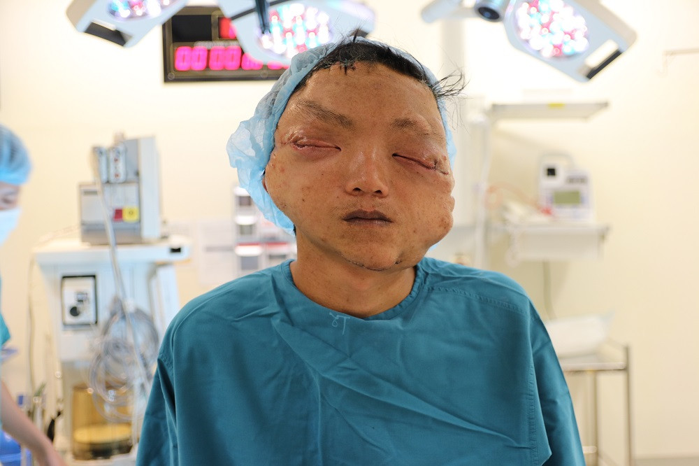 Mang khối u khổng lồ như 'mặt quỷ', người đàn ông 17 năm không dám ra khỏi nhà ảnh 4