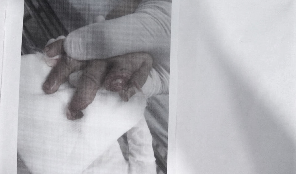 Bé trai 1 tuổi mất 4 ngón tay vì người lớn lơ là ảnh 2