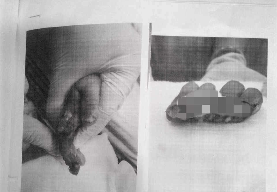 Bé trai 1 tuổi mất 4 ngón tay vì người lớn lơ là ảnh 1