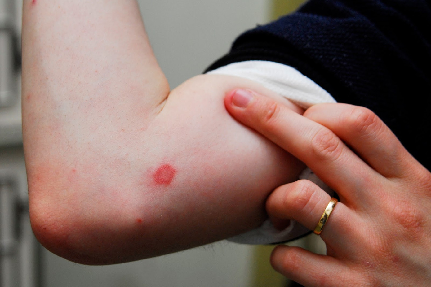 Không ít người bị nấm da khi thời tiết nồm ẩm.