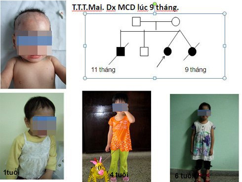 Một bé bị rối loạn chuyển hóa bẩm sinh đã được cứu sống. Đến nay bé phát triển hoàn toàn bình thường. Trước đó, một người chị song sinh và người anh trai của bé không được chẩn đoán đúng bệnh đã mất. Ảnh: Bệnh viện cung cấp. Một bé bị rối loạn chuyển hóa bẩm sinh đã được cứu sống. Đến nay bé phát triển hoàn toàn bình thường. Trước đó, một người chị song sinh và người anh trai của bé không được chẩn đoán đúng bệnh đã mất. Ảnh: Bệnh viện cung cấp