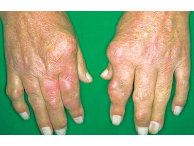 Khớp bị biến dạng. Ảnh: K.Vy (Thanh Niên) Khớp bị biến dạng