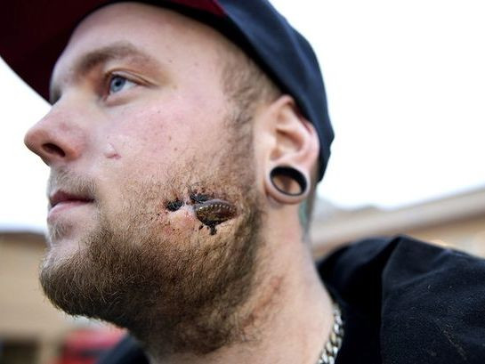 Patrick Moberg bị miếng thủy tinh mắc kẹt trong má 17 ngày không phát hiện ra