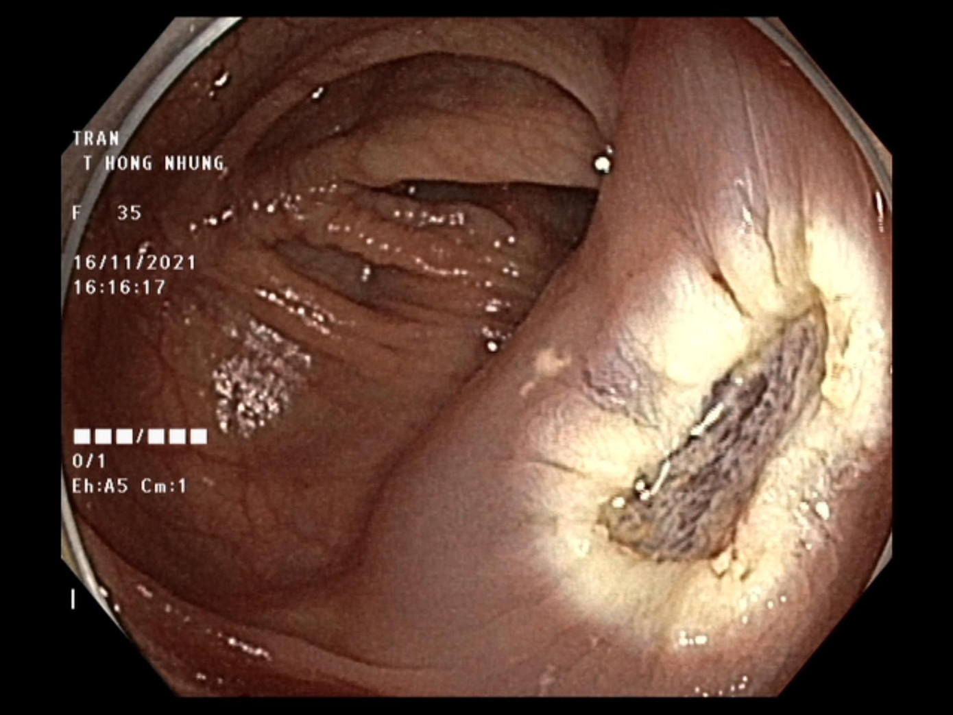 Hình ảnh đại tràng của bệnh nhân sau khi đã được cắt bỏ khối polyp Hình ảnh đại tràng của bệnh nhân sau khi đã được cắt bỏ khối polyp