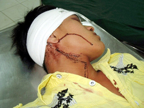 Đứng ra can ngăn nhưng anh Hoàng bị Hùng bắn vào trán gây thương tích - Ảnh có tính chất minh họa