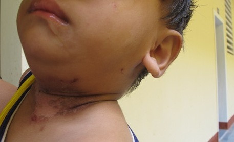 Một em bé bị kiến ba khoang tấn công. Ảnh: Dân Trí