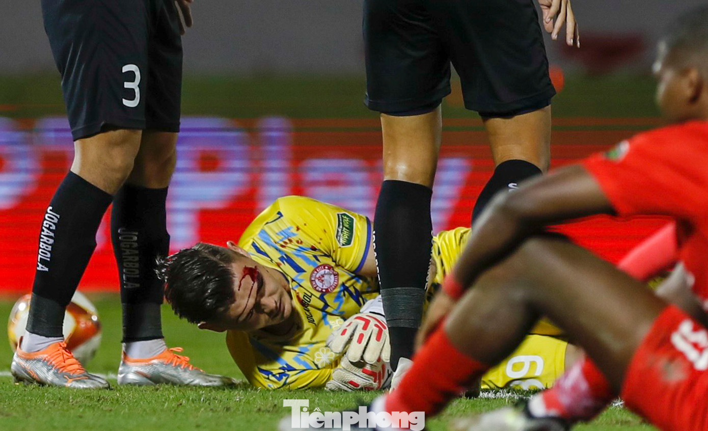 Phần đầu của Patrik Lê Giang đổ máu và thủ thành này nằm bất động khá lâu ở trên sân. Phần đầu của Patrik Lê Giang đổ máu và thủ thành này nằm bất động khá lâu ở trên sân.