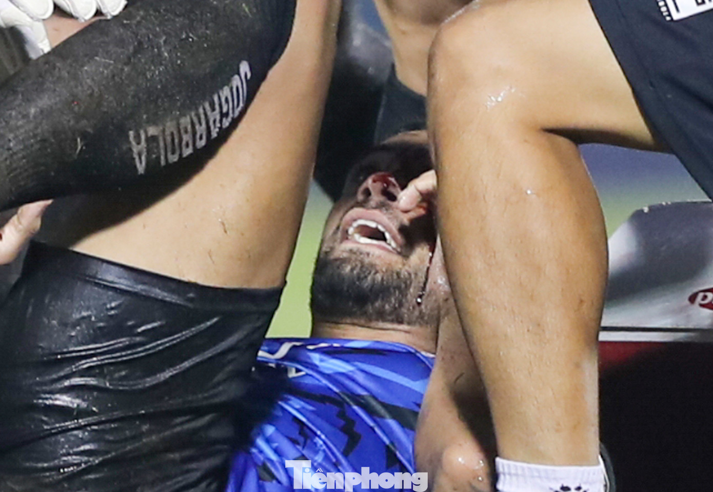 Da Silva bị rách mí mặt khá nặng, toàn bộ gương mặt của trung vệ số 43 thấm đẫm máu.