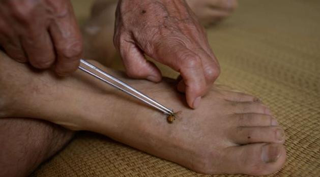 Người Trung Quốc cho rằng ong đốt chữa bệnh tốt nhất ở phần chân . Người Trung Quốc cho rằng ong đốt chữa bệnh tốt nhất ở phần chân