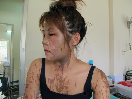 Tháng 7-2013, B. đã từng rạch mặt chị Châu