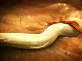  Giun móc bò trên ngực cô Allen