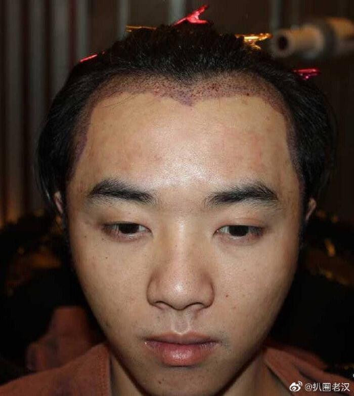 Khẳng định nam ca sĩ đi cấy tóc. Khẳng định nam ca sĩ đi cấy tóc.