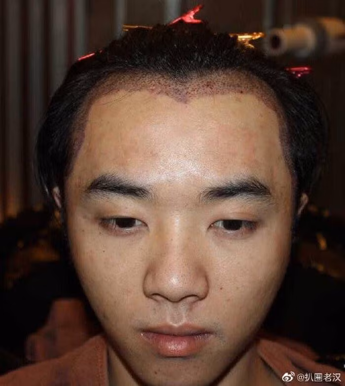 Khẳng định nam ca sĩ đi cấy tóc.