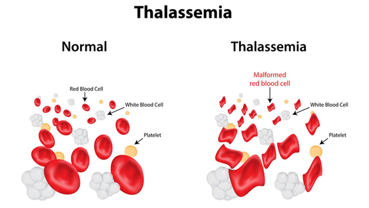 Sự khác nhau giữa các tế bào máu bình thường (bên trái) và tế bào máu Thalassemia. Sự khác nhau giữa các tế bào máu bình thường (bên trái) và tế bào máu Thalassemia.