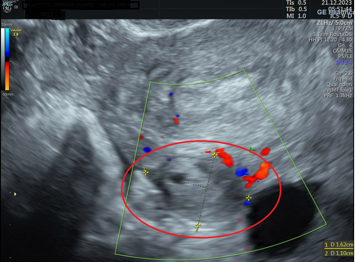 Hình ảnh siêu âm cho thấy tại buồng trứng trái có khối KT: 11x15mm nghi ngờ thai ngoài tử cung