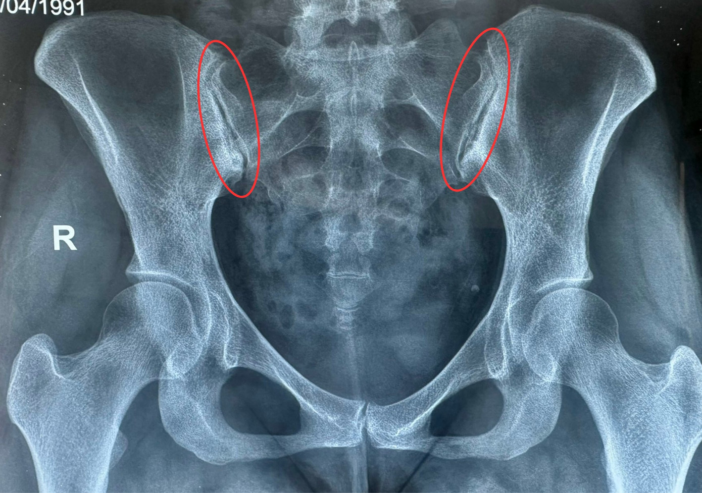 Phần khớp xương cùng chậu của bệnh nhân bị viêm sưng qua ảnh chụp MRI