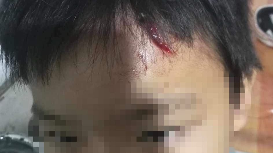 Cháu T. có nhiều vết bầm tím trên người, trán bị rách bất thường.