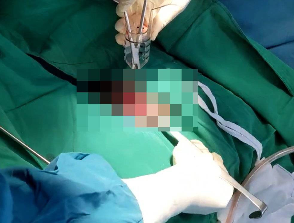 Các y, bác sĩ lấy một dương vật giả ra khỏi trực tràng của nam bệnh nhân 23 tuổi ở Cà Mau. Các y, bác sĩ lấy một dương vật giả ra khỏi trực tràng của nam bệnh nhân 23 tuổi ở Cà Mau.