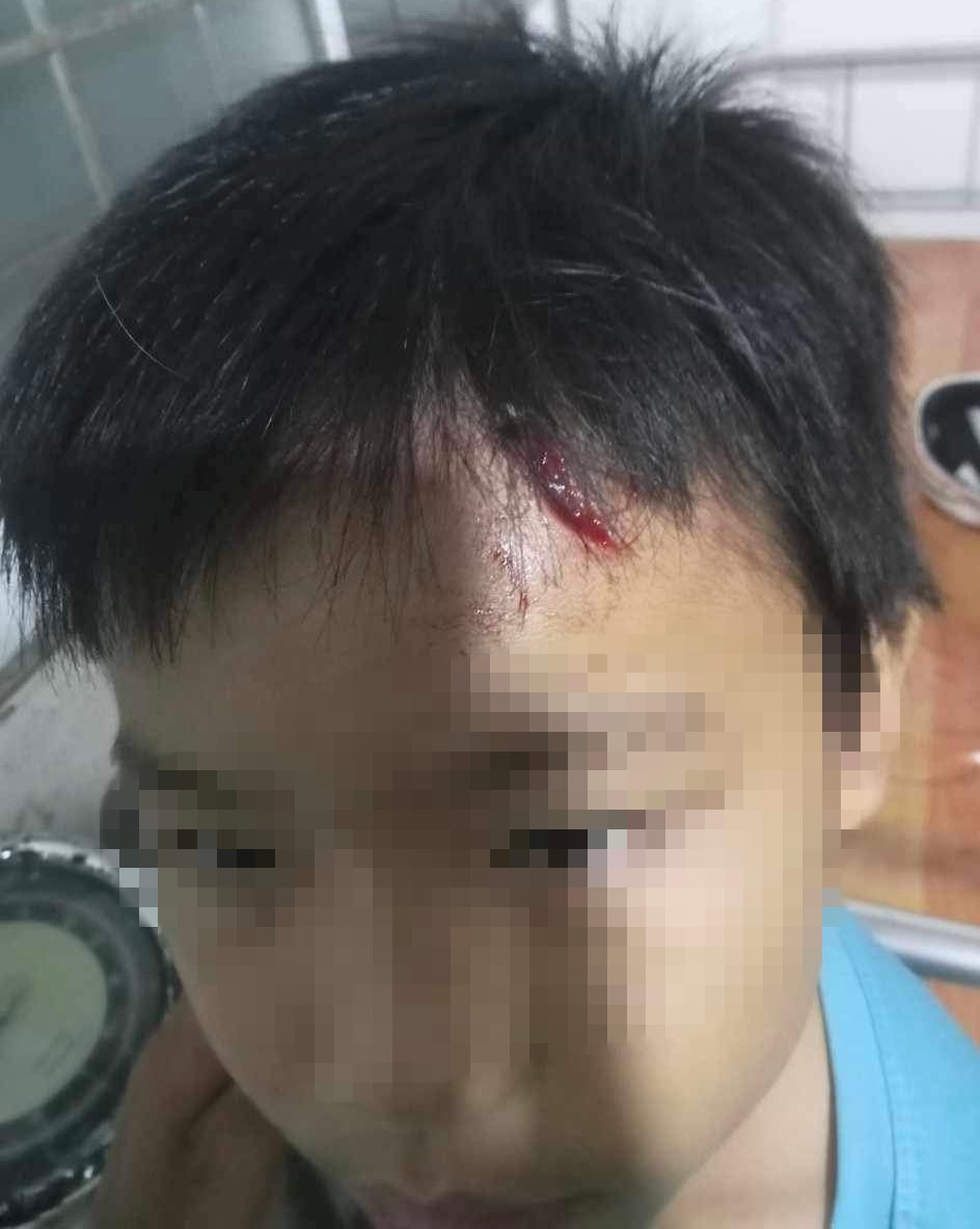 T. bị vết rách ở trán trái dài 4cm và nhiều vết bầm trên cơ thể bất thường. T. bị vết rách ở trán trái dài 4cm và nhiều vết bầm trên cơ thể bất thường.