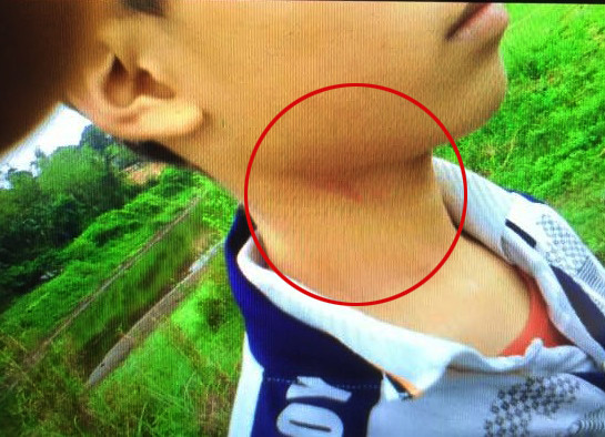 Vết xước tấy đỏ phía dưới cằm của một em học sinh bị đánh tại lớp