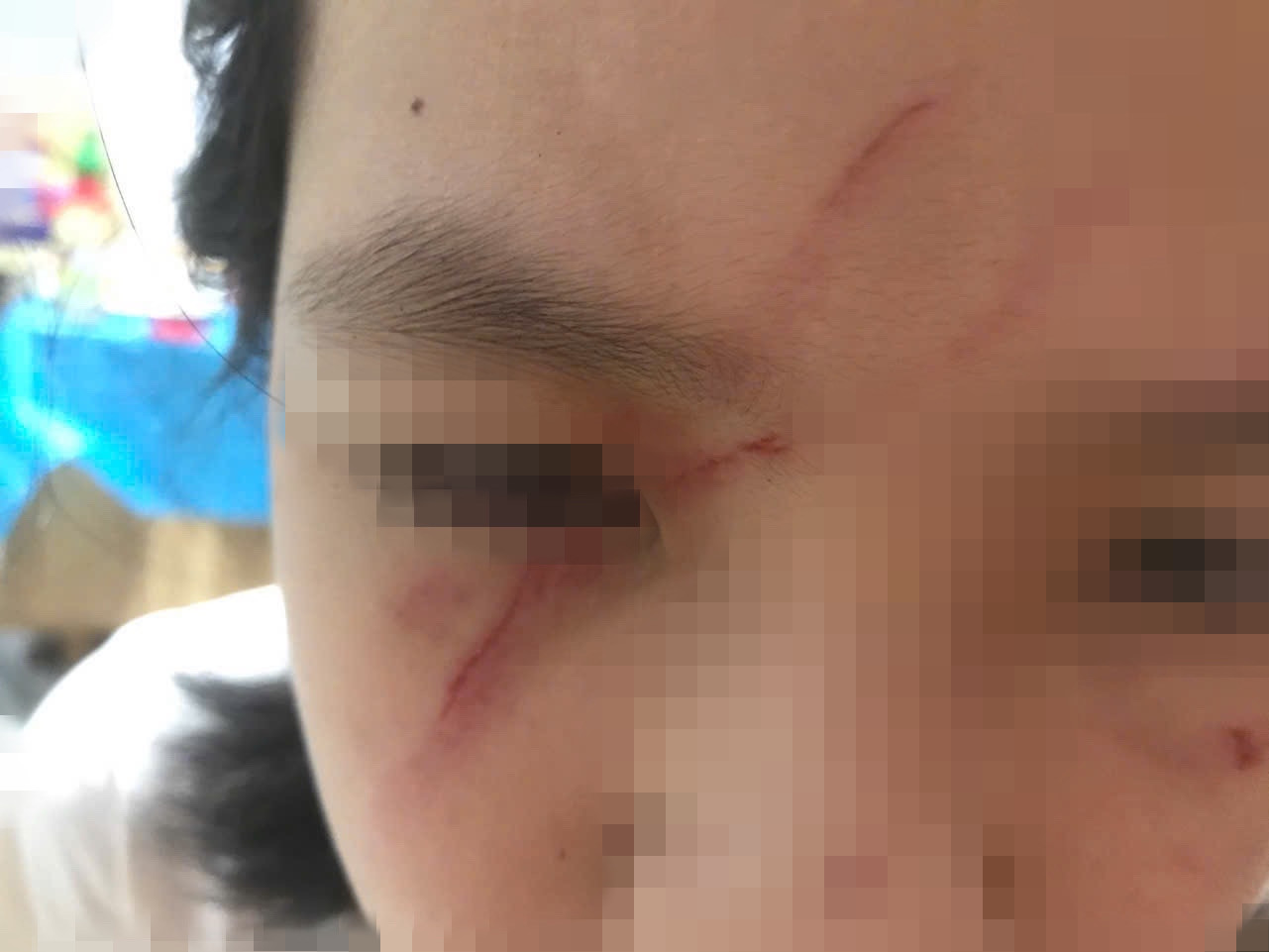 Các vết xước lớn ở mặt của cháu L. sau khi bị bạn đánh.