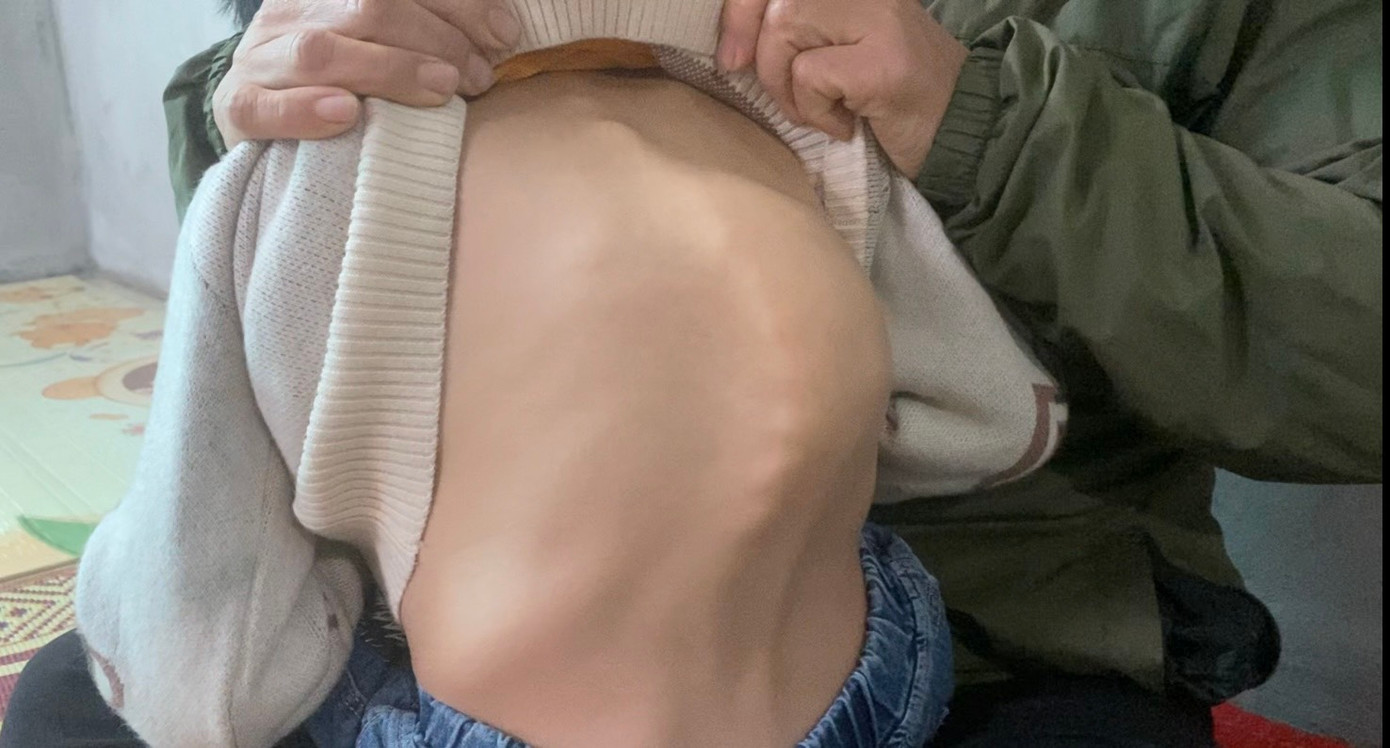 Khối u cột sống của cháu Nguyễn Đức Anh Quân. Khối u cột sống của cháu Nguyễn Đức Anh Quân.