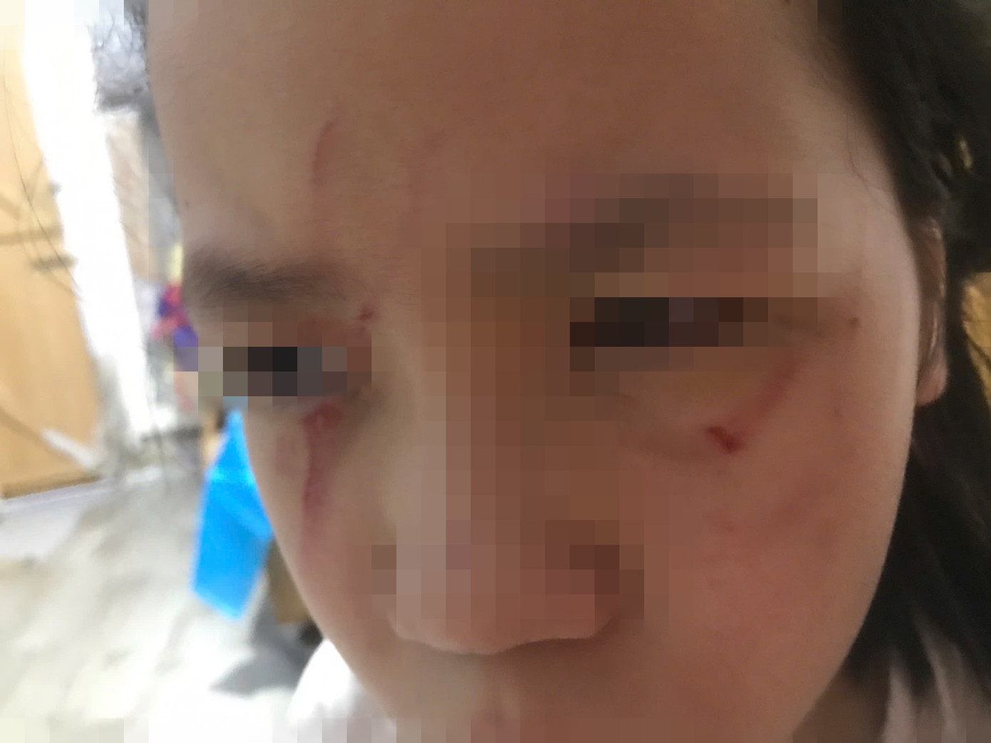 Các vết xước lớn ở mặt của cháu L. sau khi bị bạn đánh.