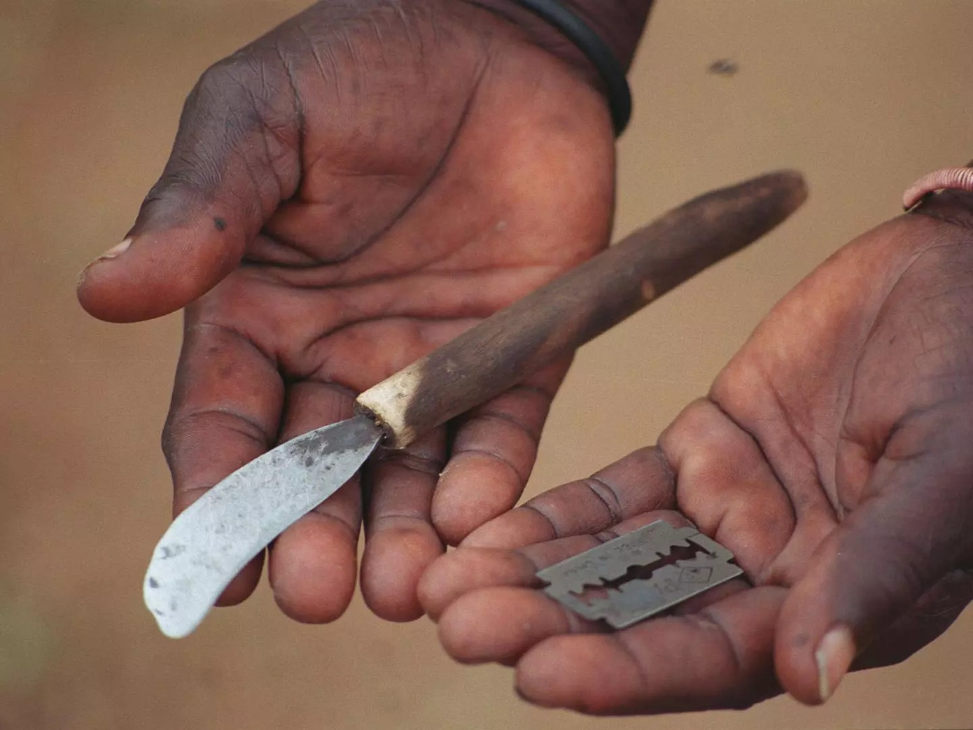 Dụng cụ để thực hiện thủ thuật FGM. Ảnh: WVI.