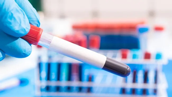 Huyết tương có thể mang dấu hiệu ung thư nhiều năm trước khi bệnh thường được chẩn đoán. Điều này có thể mở ra cánh cửa cho các biện pháp can thiệp sớm hơn. (Ảnh: Wladimir Bulgar/Thư viện Khoa học ảnh)