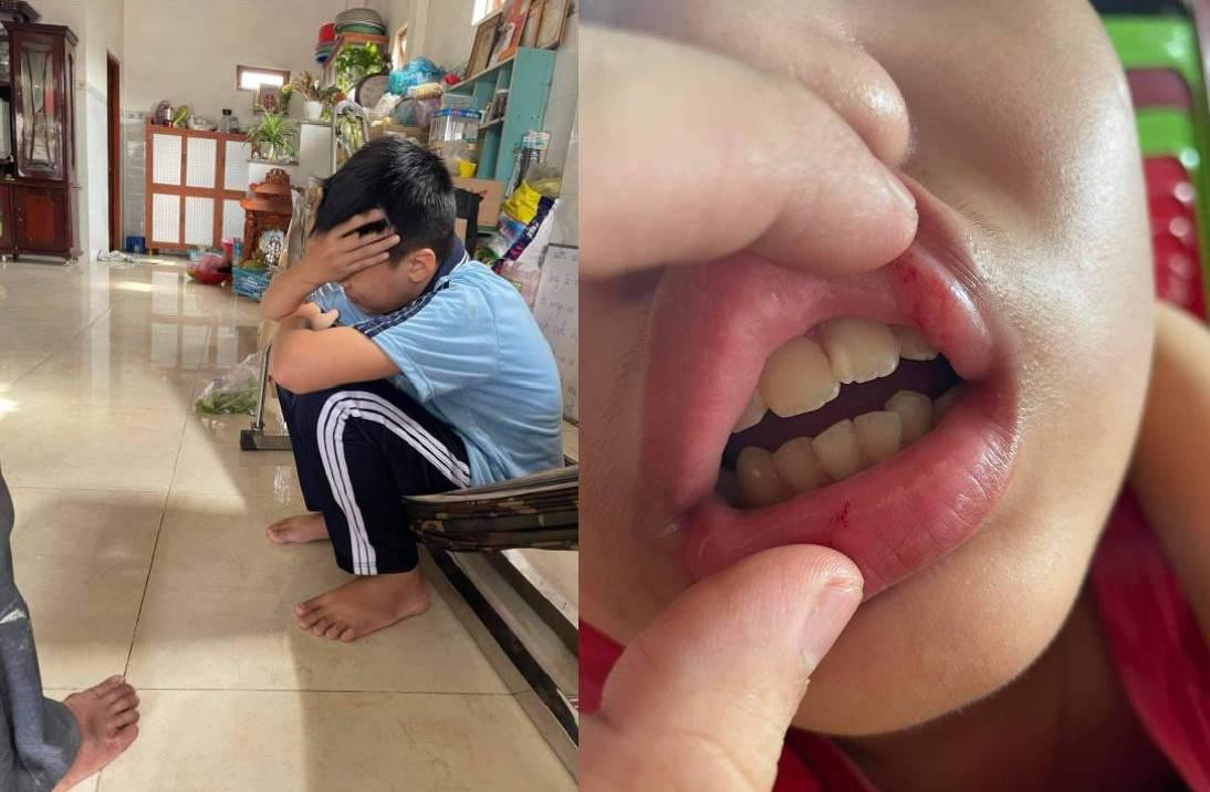 Em N. (học sinh lớp 6 trường THCS Võ Văn Tần) bị nhóm học sinh lớp đánh hội đồng 3 lần. Em N. (học sinh lớp 6 trường THCS Võ Văn Tần) bị nhóm học sinh lớp đánh hội đồng 3 lần.