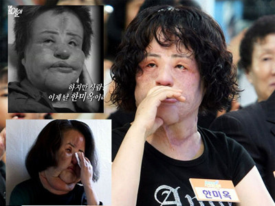 Han Mi Ok với gương mặt dị dạng