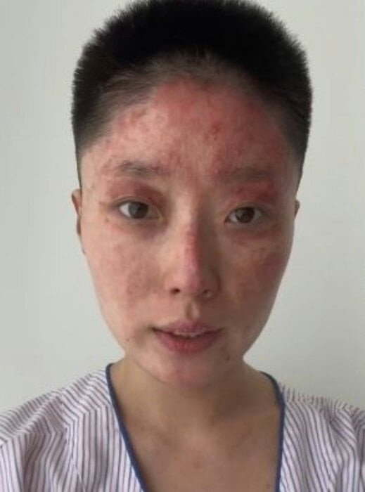 Đồng Dao lúc mới bị bỏng và sau thời gian phục hồi.