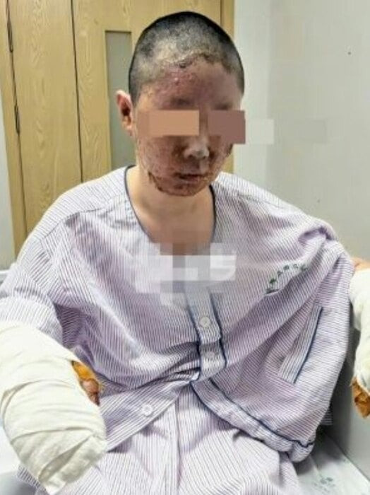 Đồng Dao lúc mới bị bỏng và sau thời gian phục hồi.