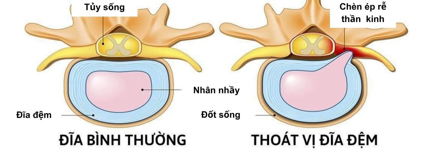 Đĩa đệm bình thường và đĩa đệm bị thoát vị.