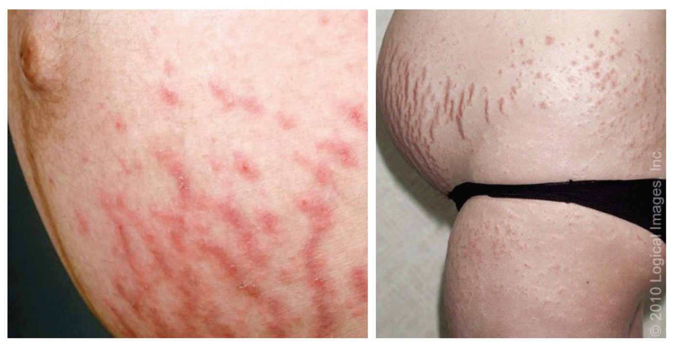 Theo thống kê, có tới 40% số phụ nữ khi mang thai gặp phải tình trạng này.