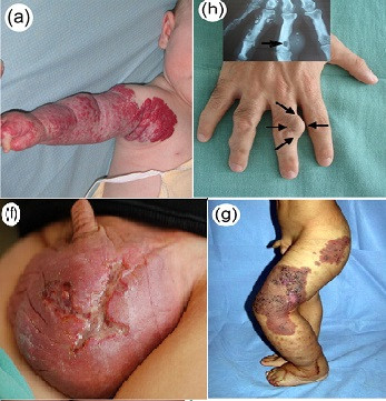 Ðề phòng u sụn lành tính trở thành ung thư