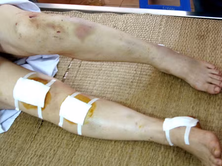Vết thương trên chân chị Hằng