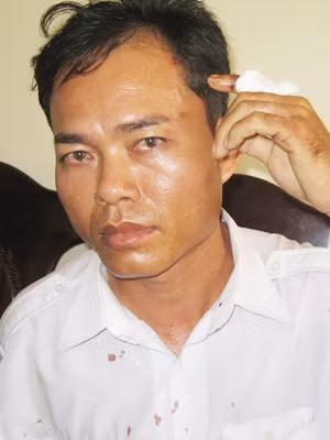Ngón tay và thái dương anh Thái bị thương, máu bắn ra áo Ảnh: Hồng Thủy
