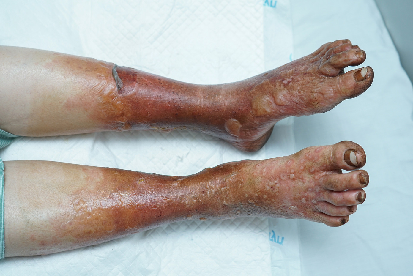 Các bác sĩ chẩn đoán bà bị viêm da tiếp xúc dị ứng mức độ nặng, được chỉ định dùng thuốc chống viêm, kháng sinh kết hợp chăm sóc tổn thương chuyên sâu để kiểm soát và ngăn ngừa biến chứng. Ảnh: Bệnh viện cung cấp