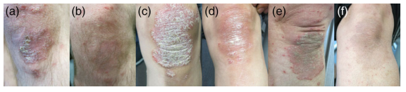 Điều trị hiệu quả bệnh vẩy nến bằng kết hợp thảo dược ảnh 2