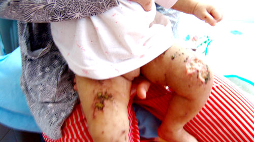 Những vết thương ở chân cháu Như Ý - Ảnh: Tuổi trẻ