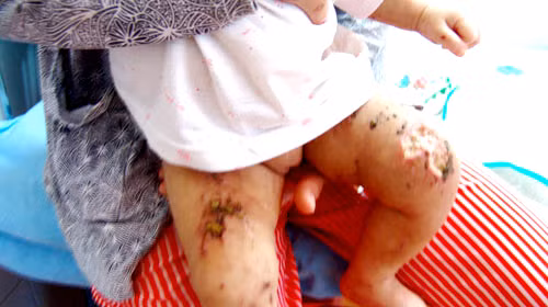 Những vết thương ở chân cháu Như Ý - Ảnh: Tuổi trẻ