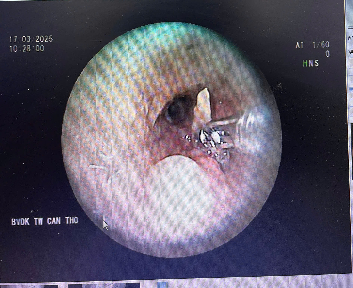 Chiếc xương (nghi xương vịt) trong phổi bệnh nhân H. (Ảnh: BVCC).